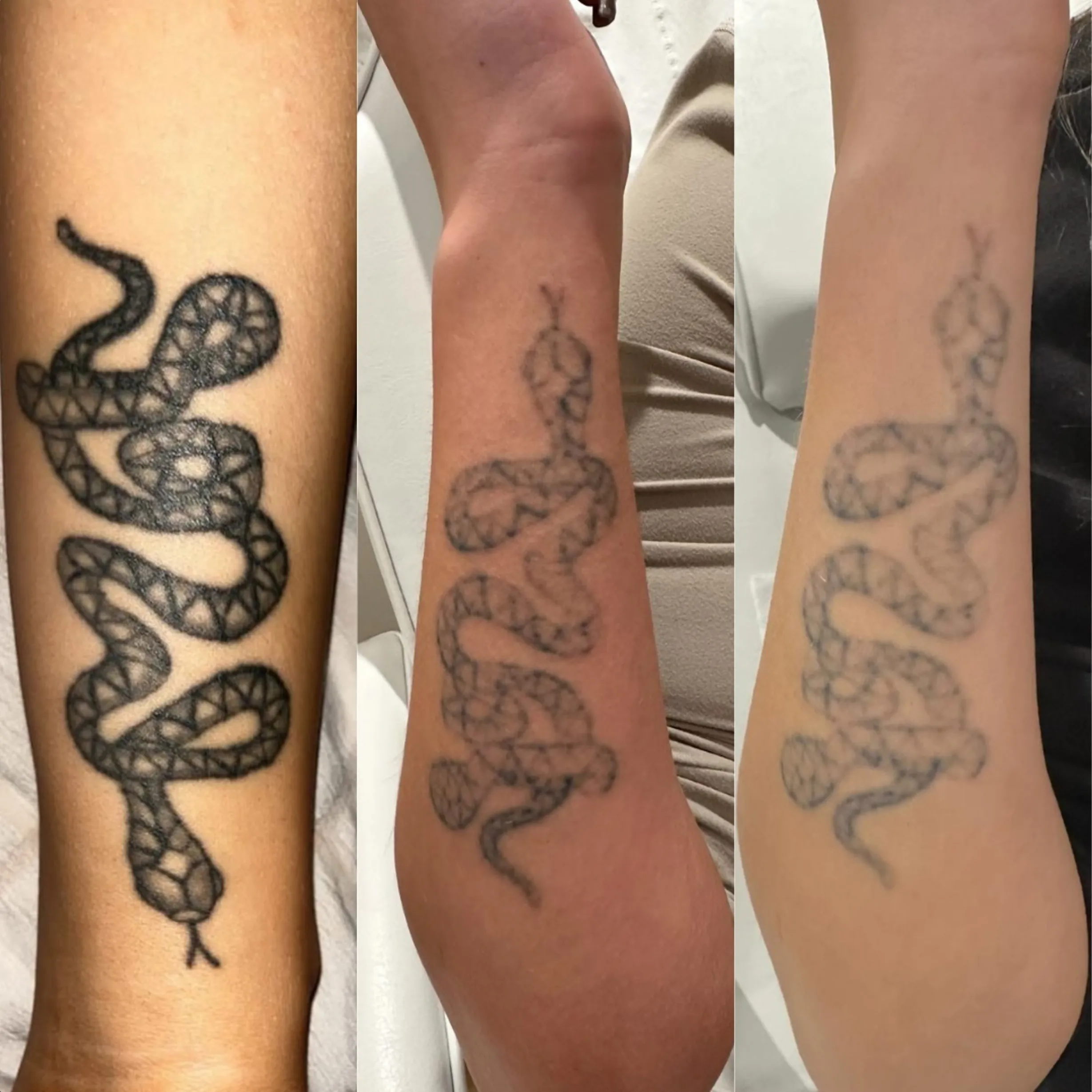 best laser for tattoo removal