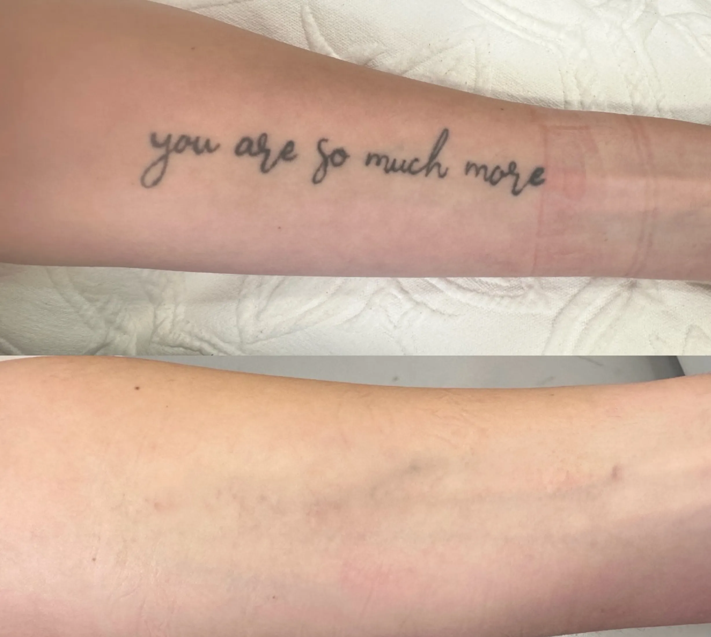 tattoo removal before and after