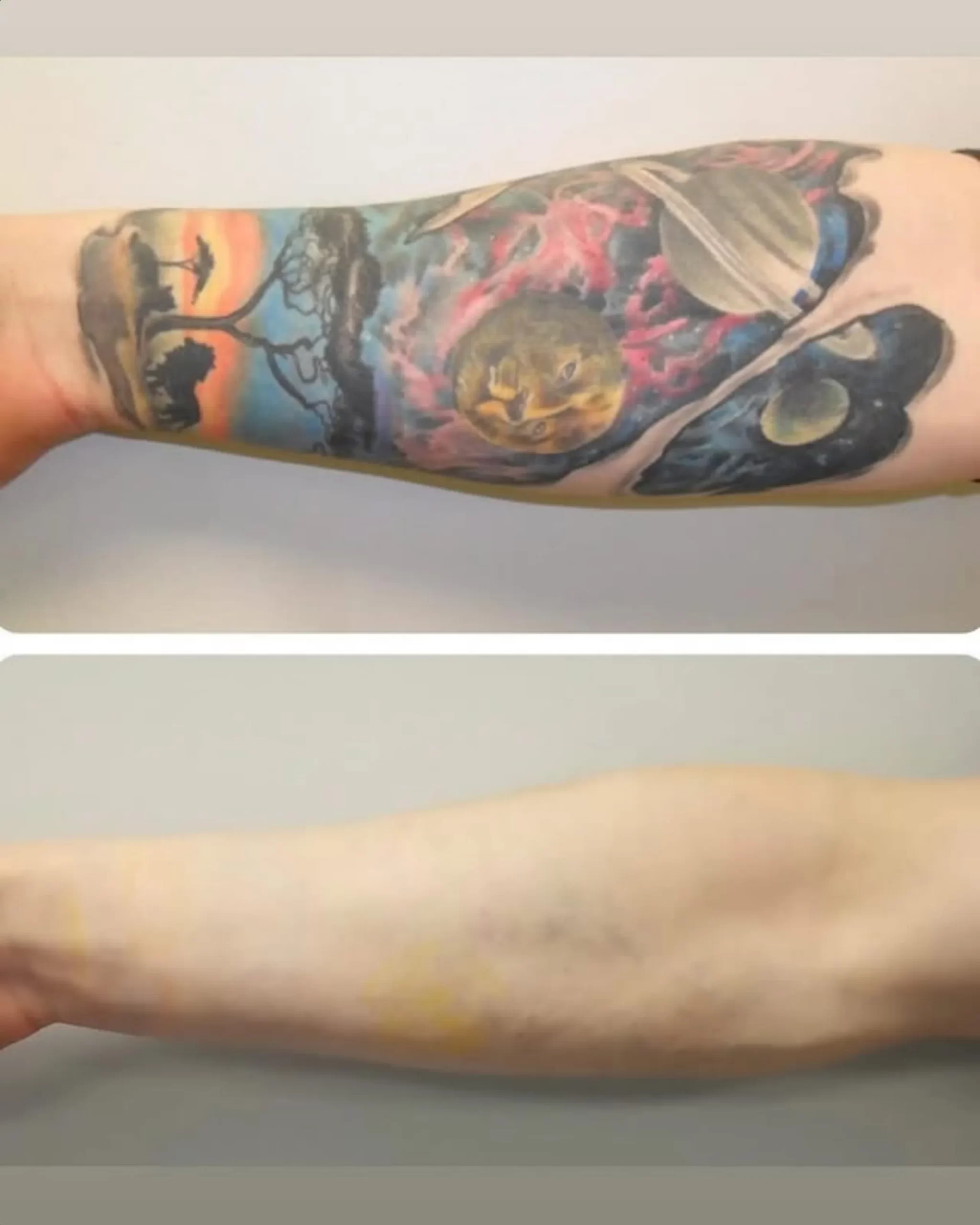 how many sessions to remove tattoo