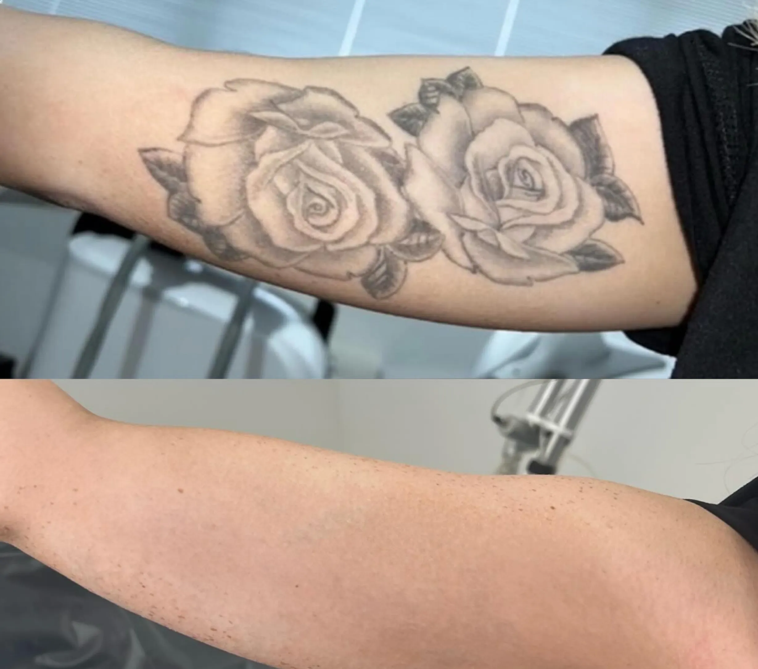 Can a Tattoo be Removed Completely