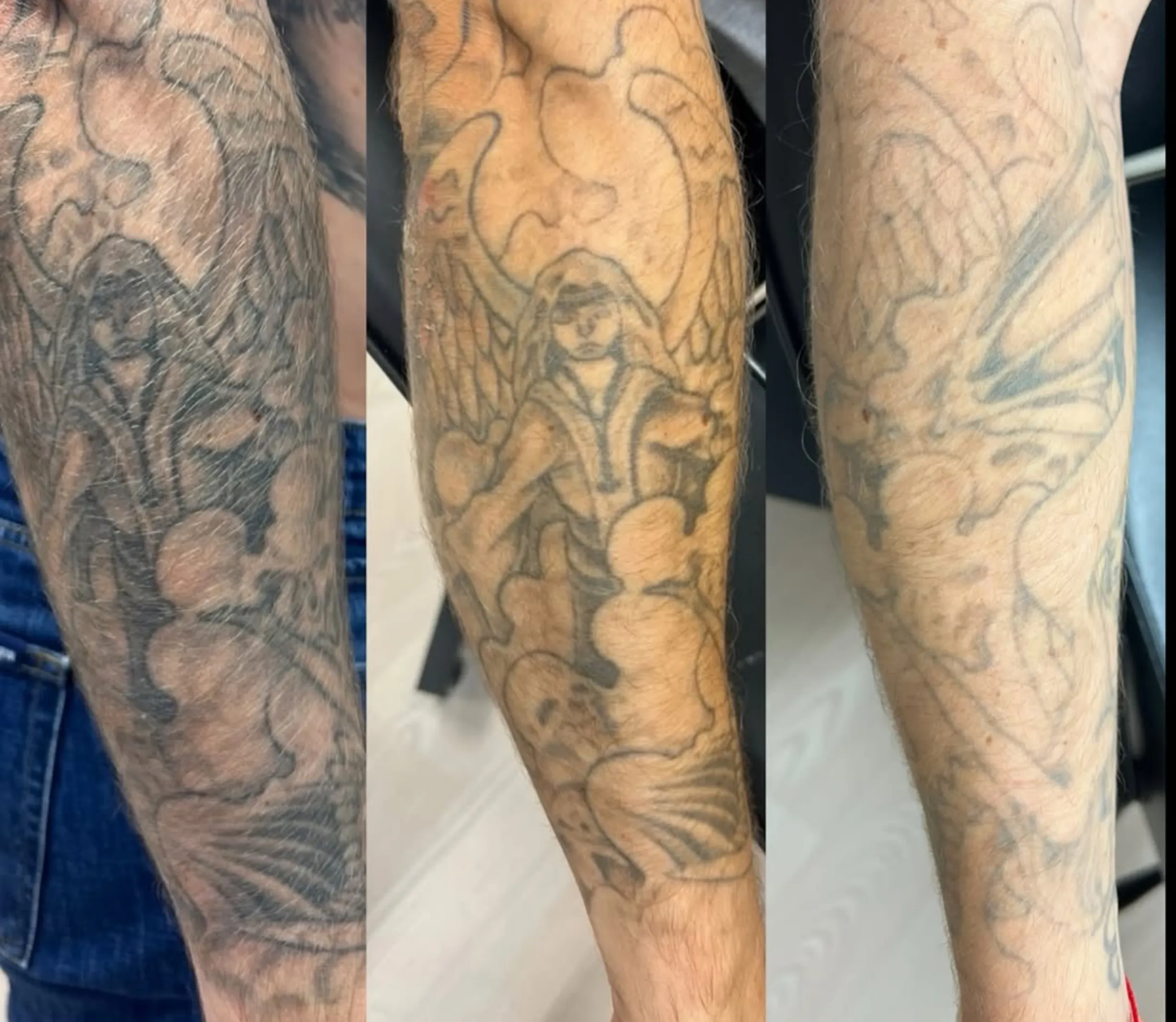 complete tattoo removal